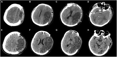 Development and validation of a prognostic computed tomography scoring model for functional outcomes in patients with large hemispheric infarction following decompressive craniectomy